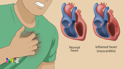 Myocarditis