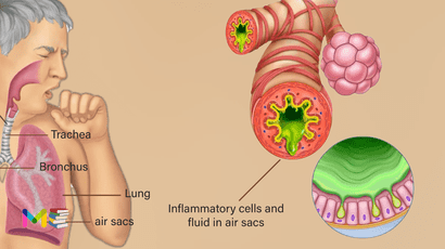 Pneumonia