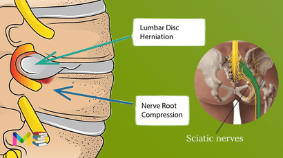 Sciatica