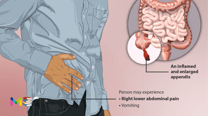 Appendicitis