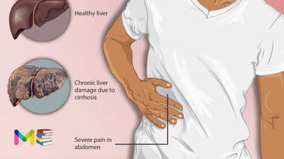 Liver cirrhosis