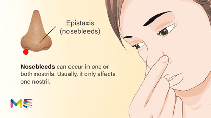 Epistaxis