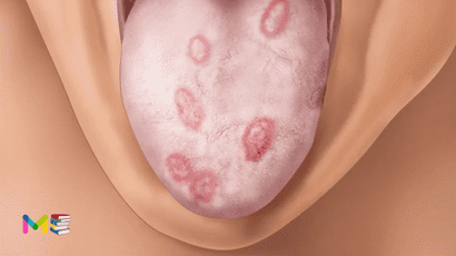 Syphilis