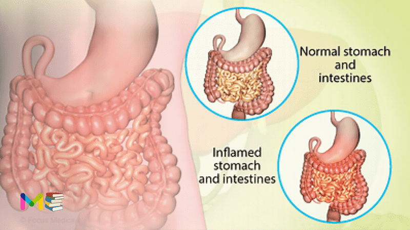 Gastroenteritis