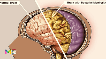 Meningitis
