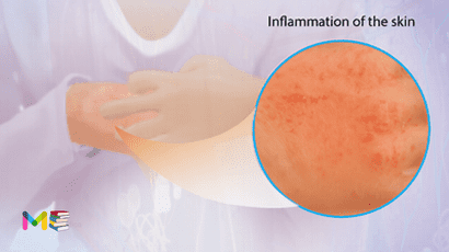 Eczema