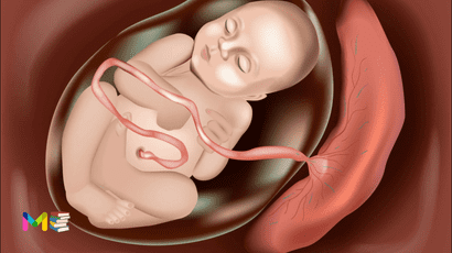 Oligohyramnios (Amniotic fluid deficiency)