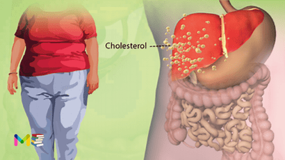 High cholesterol
