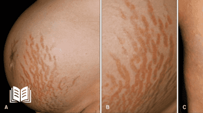 Polymorphic eruption of pregnancy