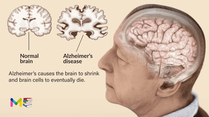 Alzheimer’s disease