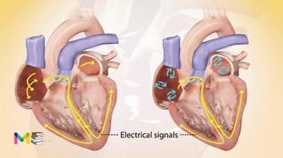 Atrial fibrillation