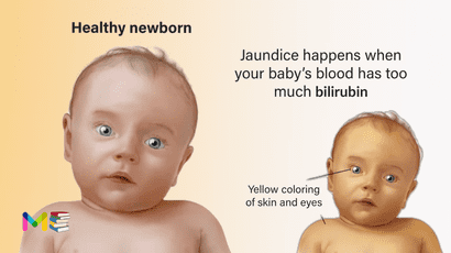 jaundice