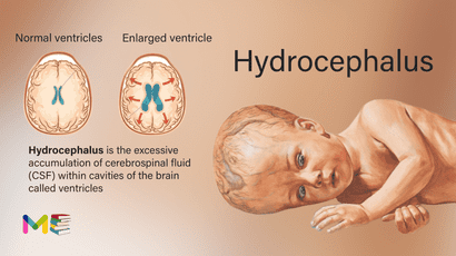 Hydrocephalus