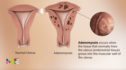 Adenomyosis