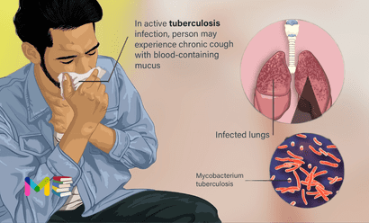 Tuberculosis