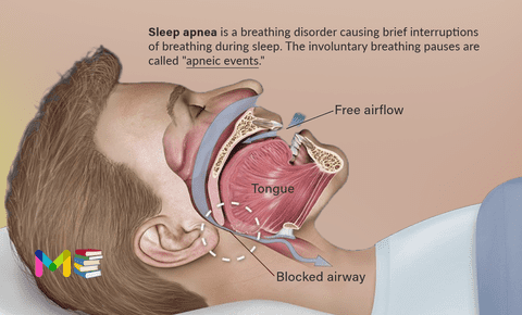 Sleep apnea