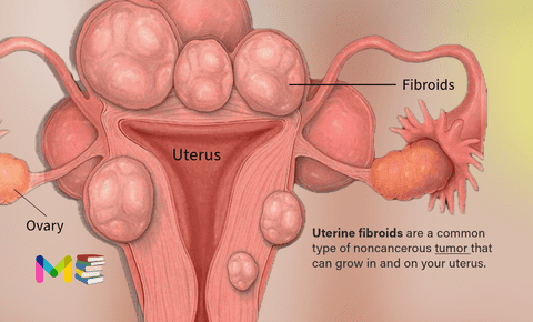 Uterine fibroids