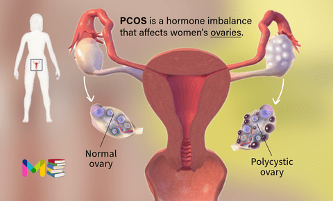 Polycystic ovary syndrome