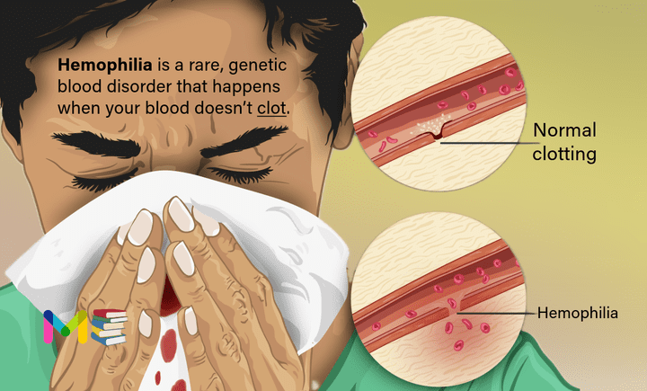 Hemophilia