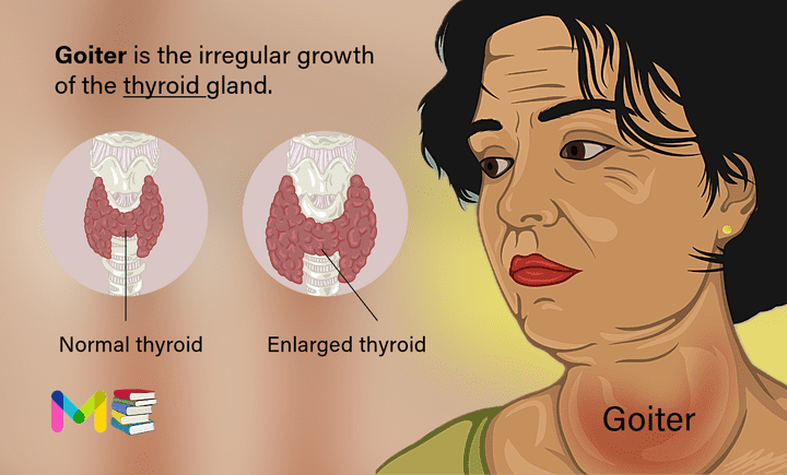 Goiter