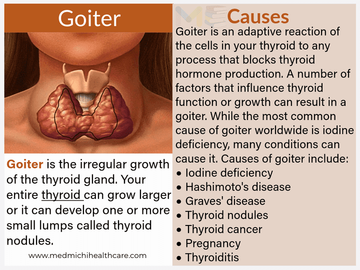 All Disease Causes Short Notes 10 Goiter