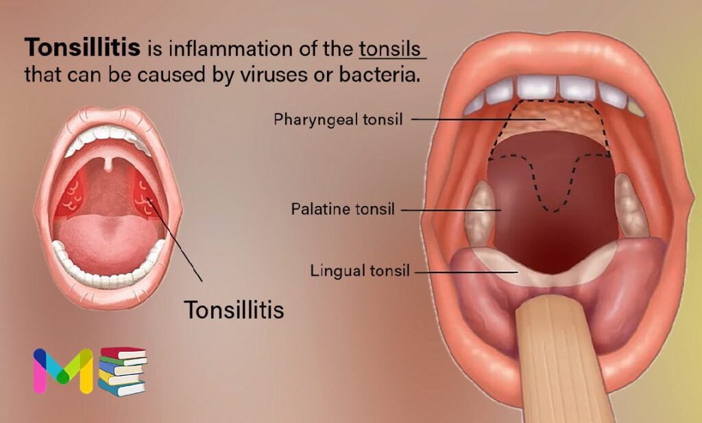 Tonsillitis