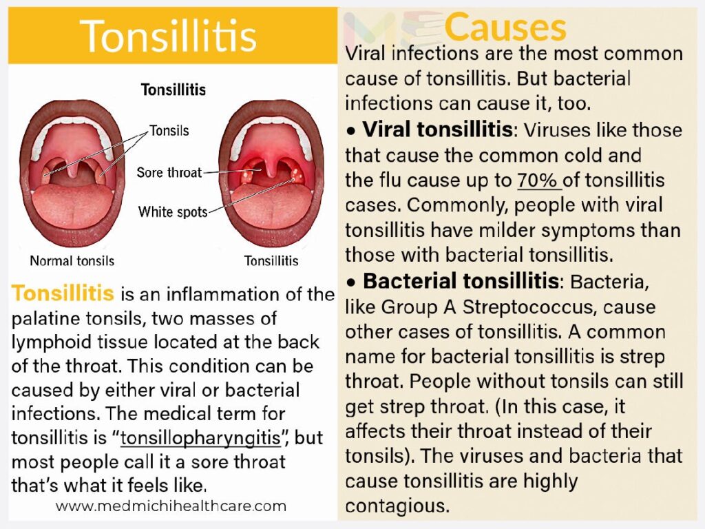 All Disease Causes Short Notes 6 Tonsillitis