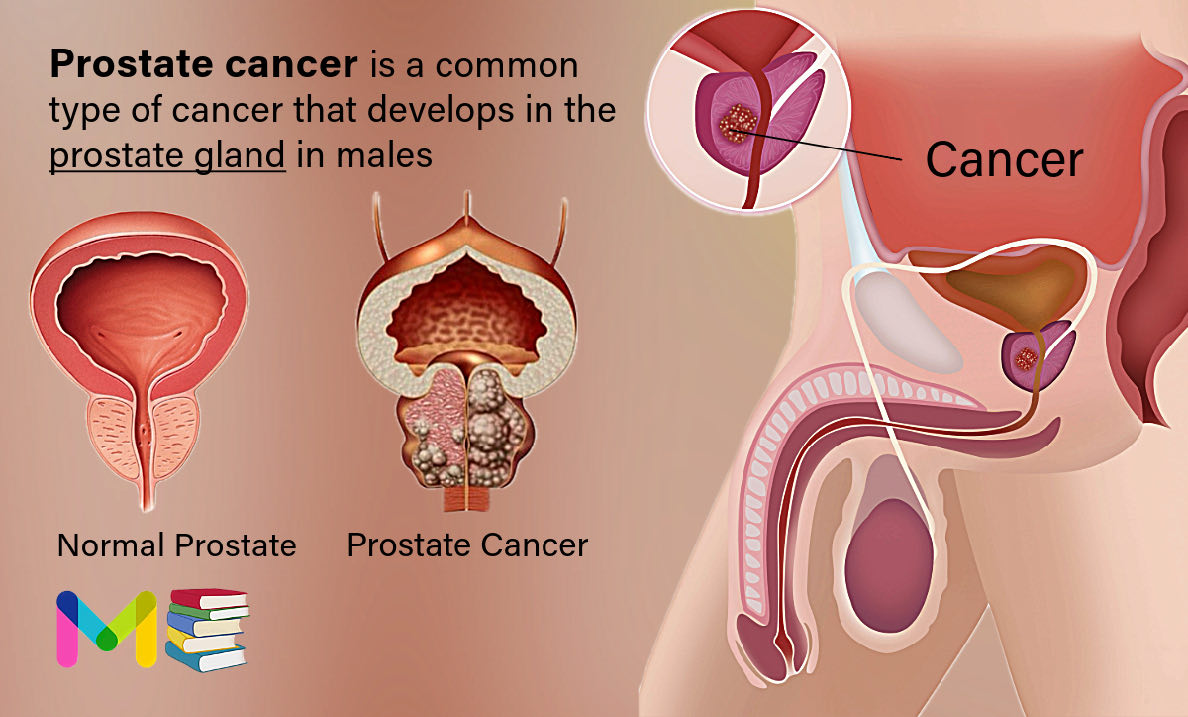 Prostate Cancer: Types, Causes, Symptoms, Diagnosis & Treatment