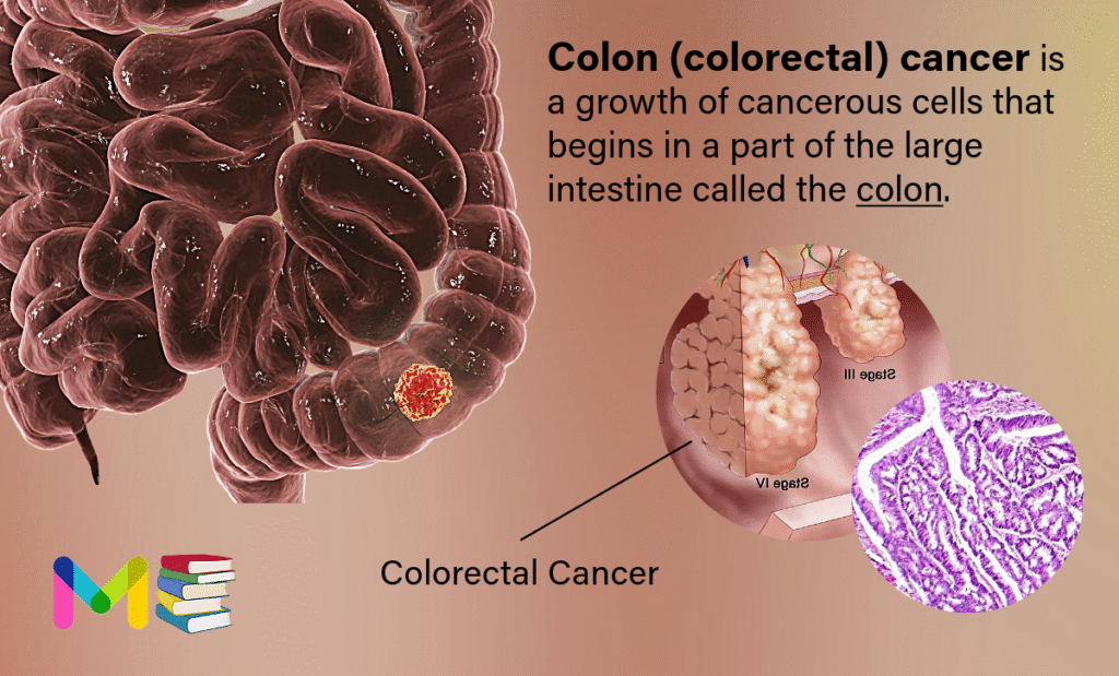 Colon cancer