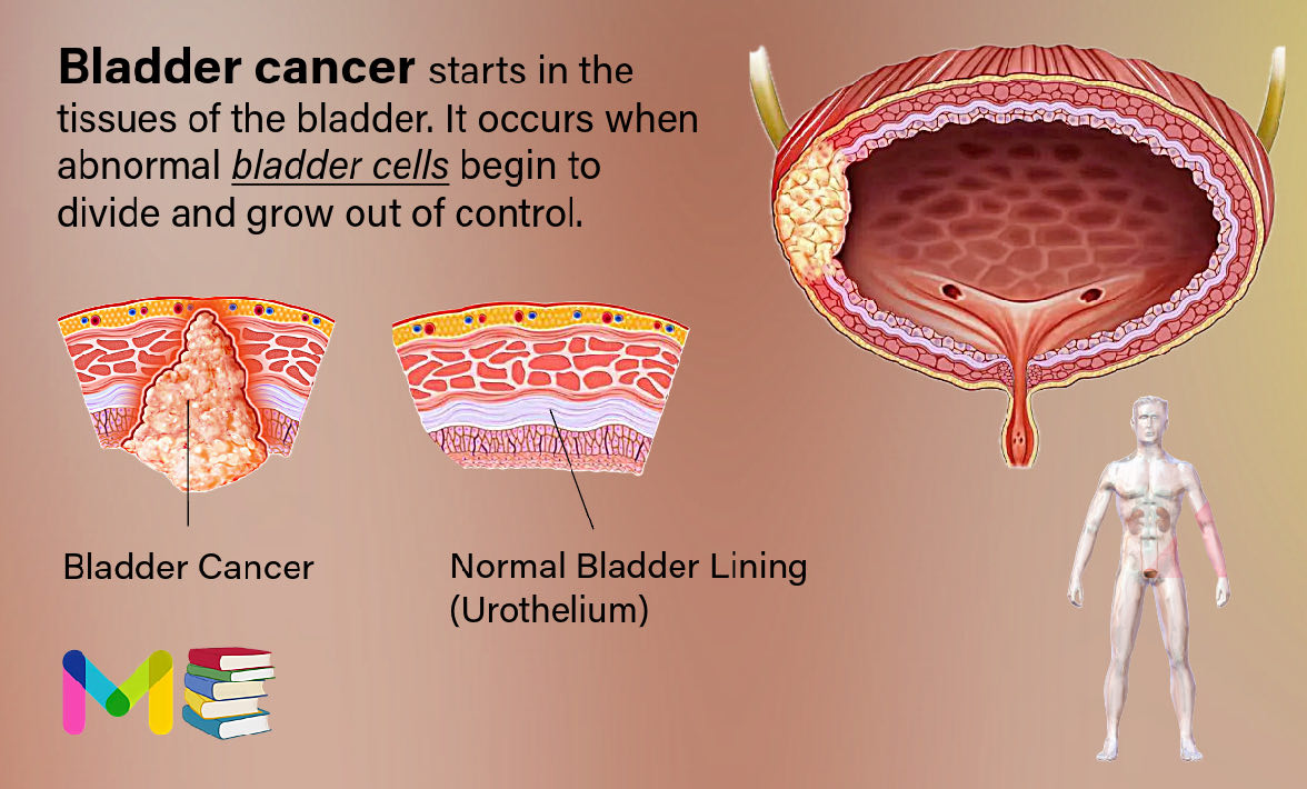 Bladder Cancer: Types, Causes, Symptoms, Diagnosis & Treatment
