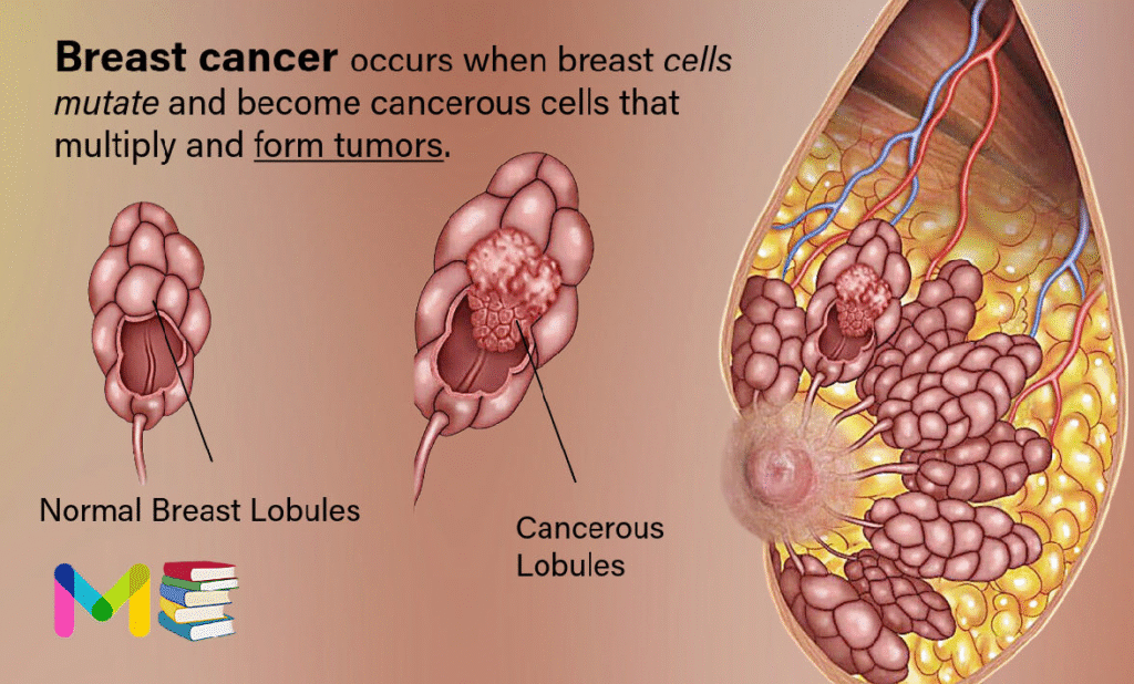 Breast Cancer: Types, Causes, Symptoms, Diagnosis & Treatment 2 Breast cancer