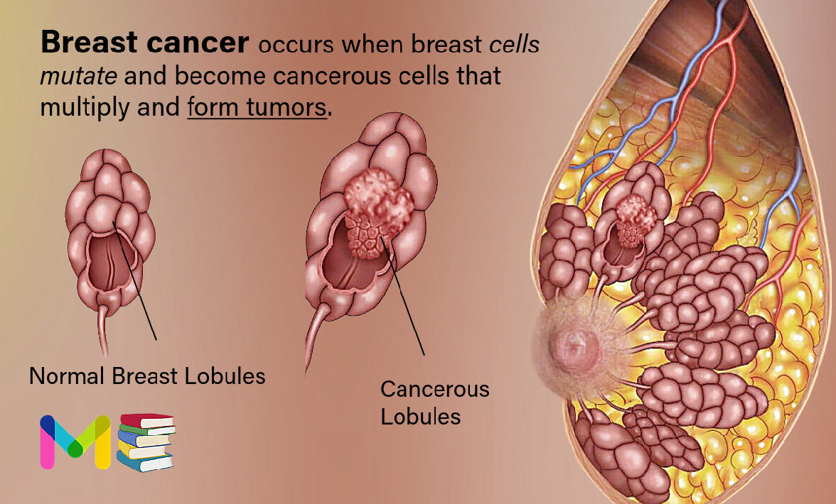 Breast Cancer: Types, Causes, Symptoms, Diagnosis & Treatment 1 Breast Cancer: Types, Causes, Symptoms, Diagnosis & Treatment