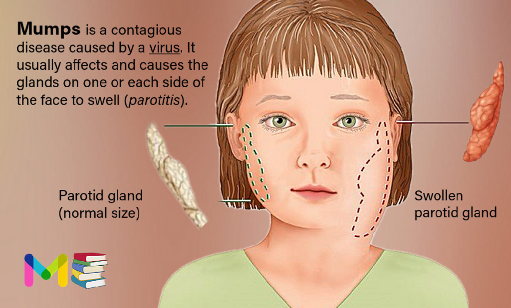 Mumps: Causes, Symptoms, Diagnosis & Treatment 2 35c7804f 5cfc 44b2 8642 382994f65518 l0 001 1772619708 transformed